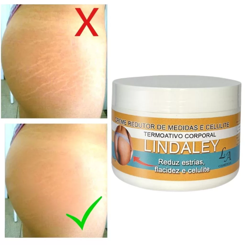 Creme Anti Estrias Removedor de Estrias 300g Lindaley Resultados Reais
