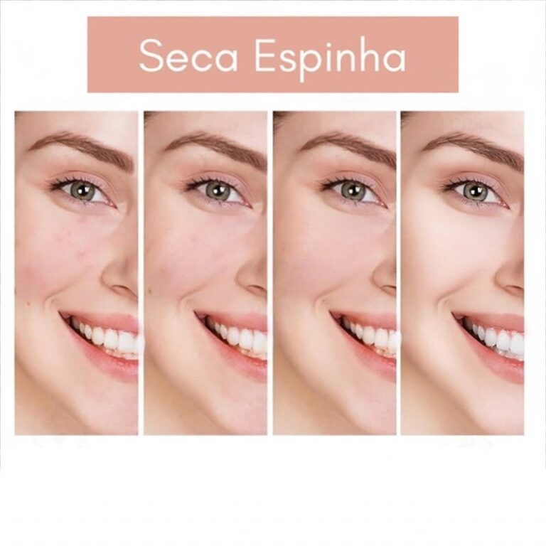 100 Adesivos para Espinha e Acnes Hidrocoloide