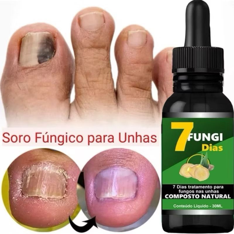 Micose de Unhas fungi7  Reparador Para Unhas Com Fungos  ANTI MICOSE