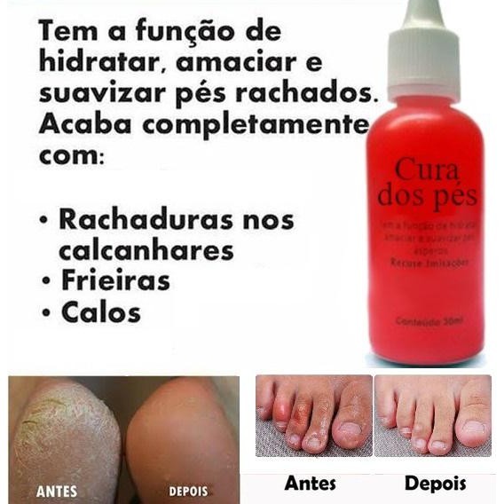 Deixar O Pés Rachado E Sangrando