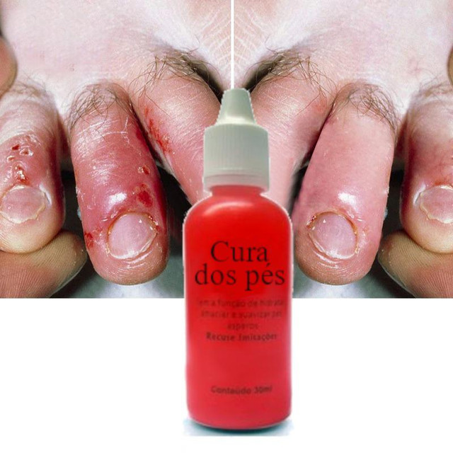 Deixar O Pés Rachadura De Pé