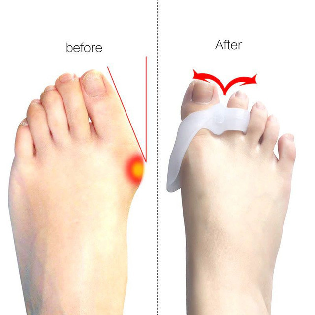 Corretor Joanete Gel Confortavel