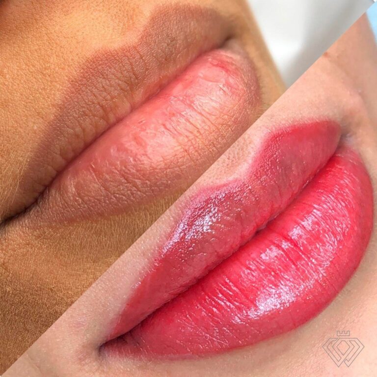 [KIT ]HIDRA LIP PARA  DERMAPEN ESFOLIANTE+ HIALUR