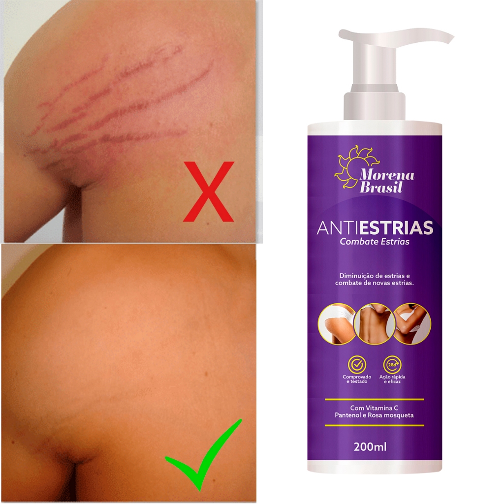 Creme Anti Estrias Removedor Estrias 200g Morena Brasil  Ação Poderosa com Colágeno e Elastina