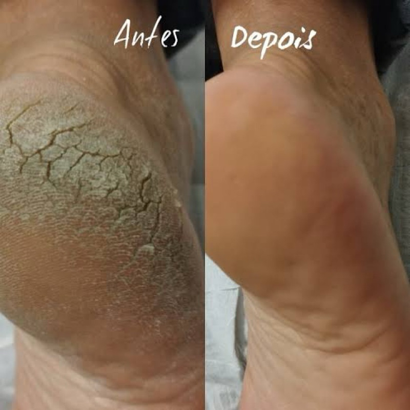 Creme do Pedreiro 500g  para Pé Ressecado Pele Aspera Creme de Ureia 240g  Hidratante Corporal