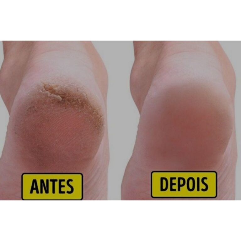 Creme cicatrizante de Rachaduras dos pés S.O.S UR