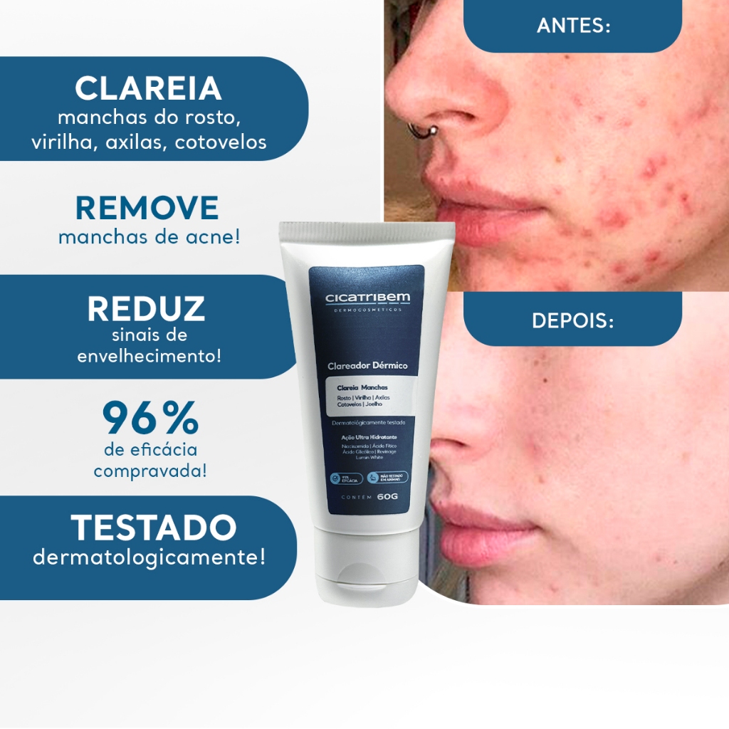 Clareador de Manchas para Virilha, Axilas e Melasma 60g – Creme Clareador – Cicatribem