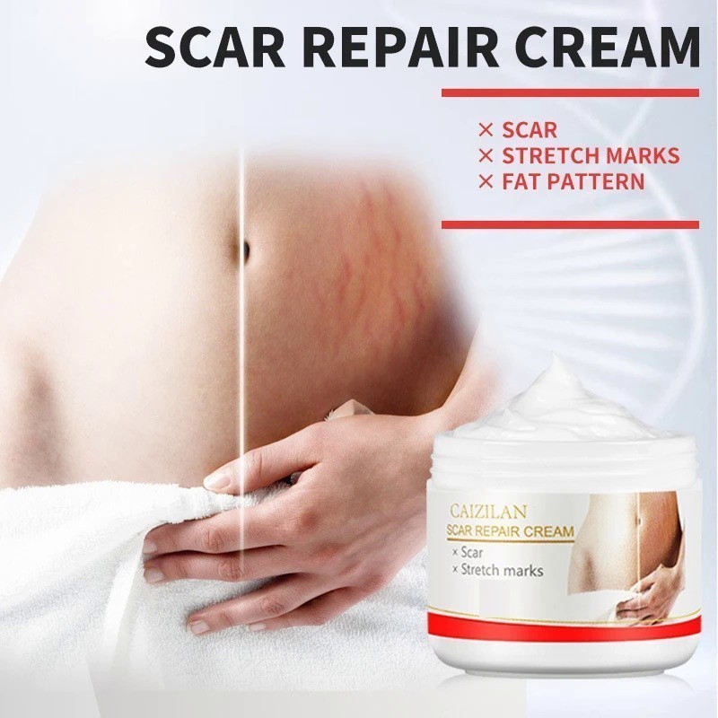 Creme De Reparo De Cicatrizes Cuidados Com A Pele Remoção De Estrias Tratamento Para Mulheres Grávid