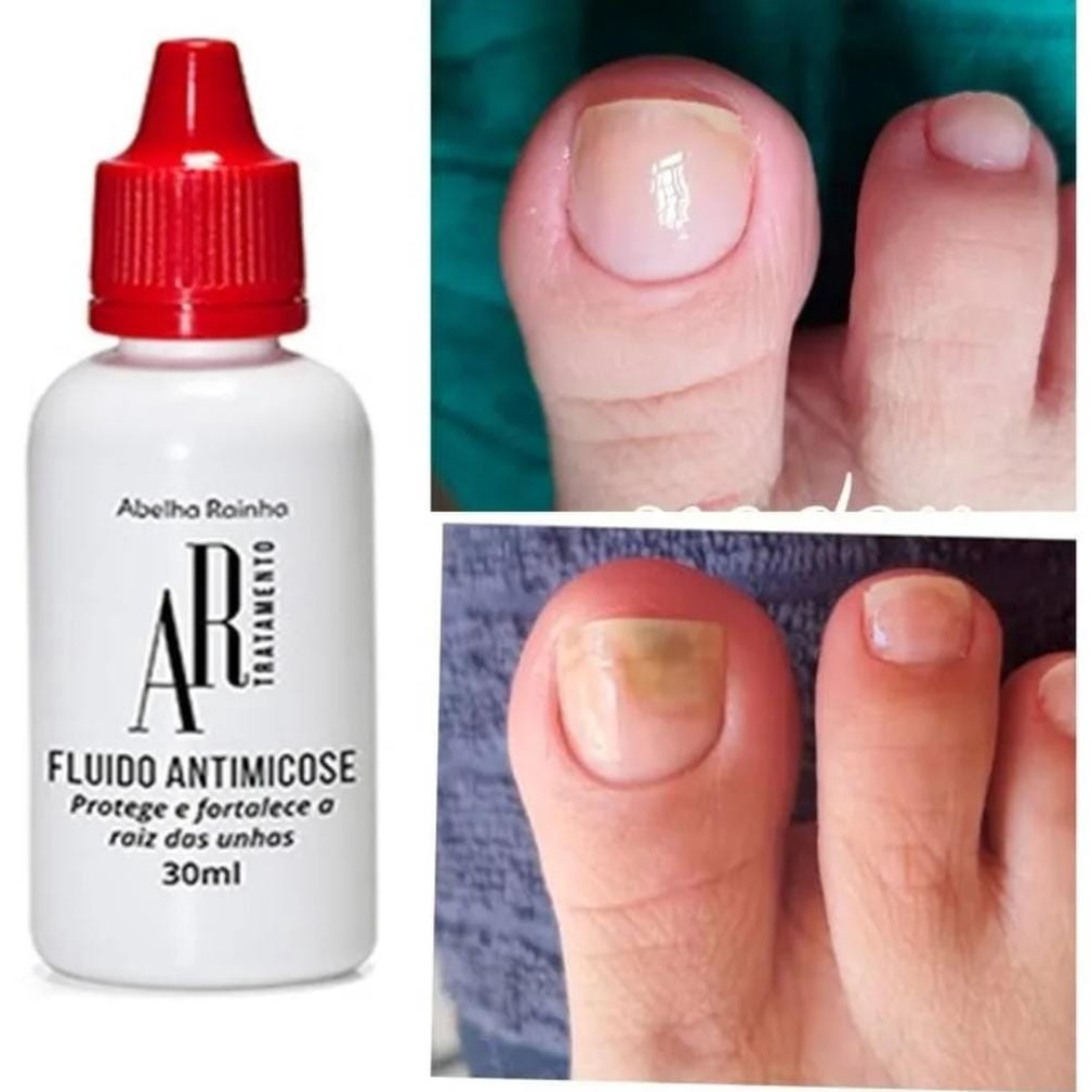 Fluido Anti Micose Para Unhas e Pés AR Tratamento