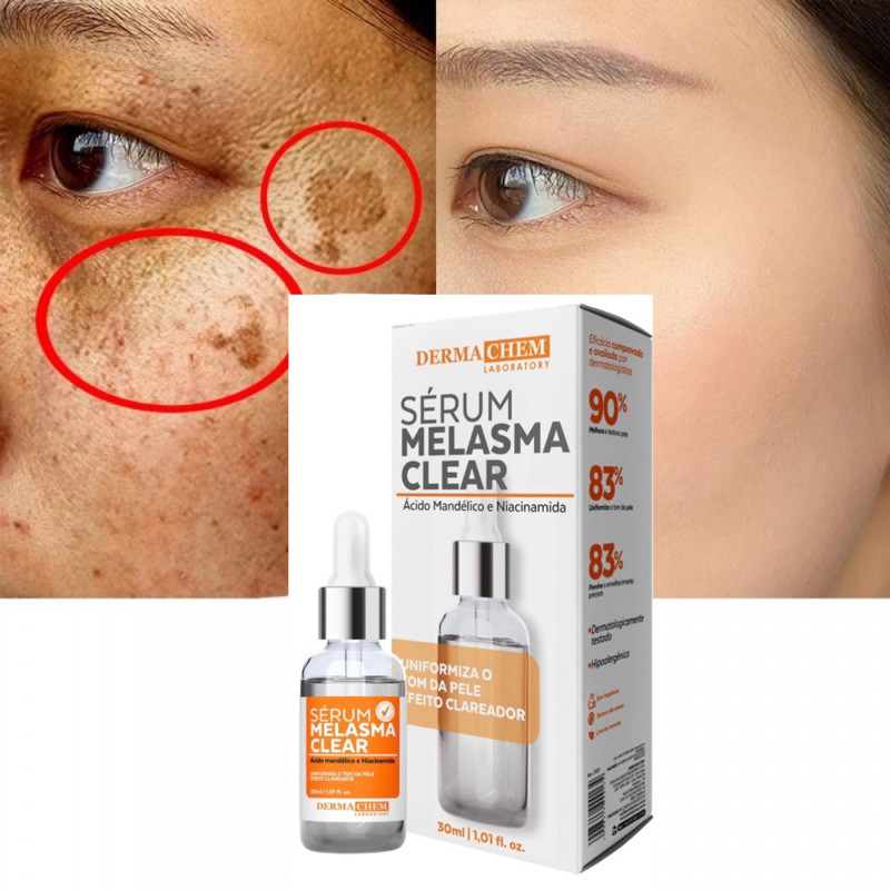 Sérum Clareador de Melasma Uniformiza o tom da Pe