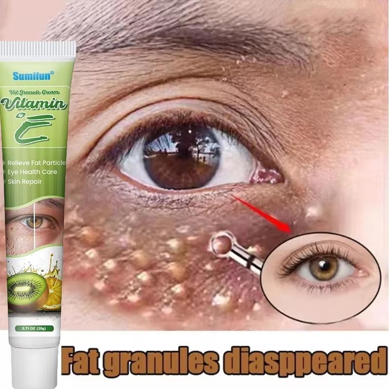 Grânulos De Gordura Removedor Creme Para Os Olhos
