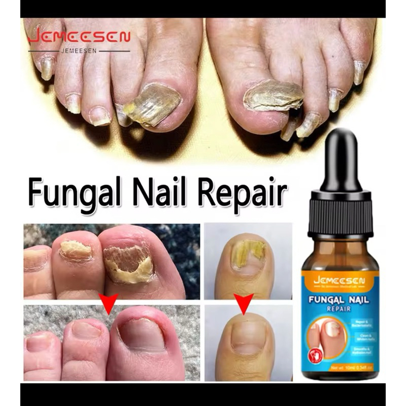1 tratamento  para micose fungal  recuperação de