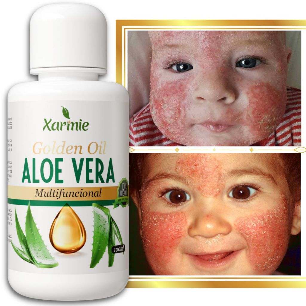 Óleo Aloe Vera para Bebê  Dermatites e Alergias