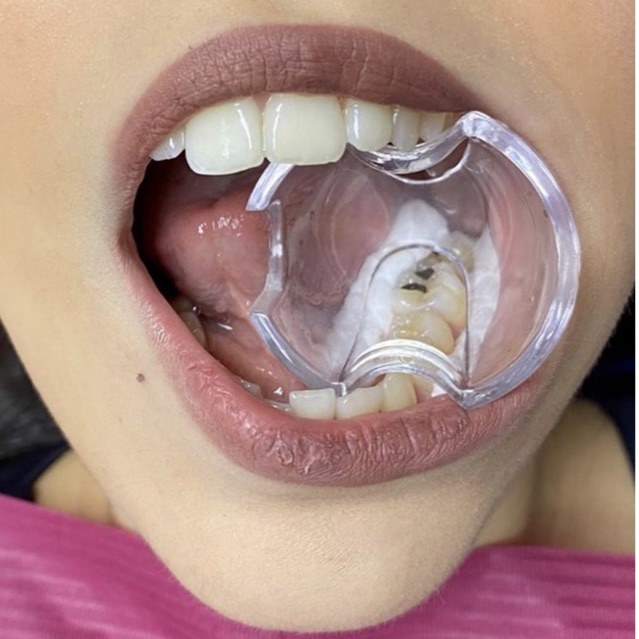 Abridor de boca Lysanda – isolamento relativ