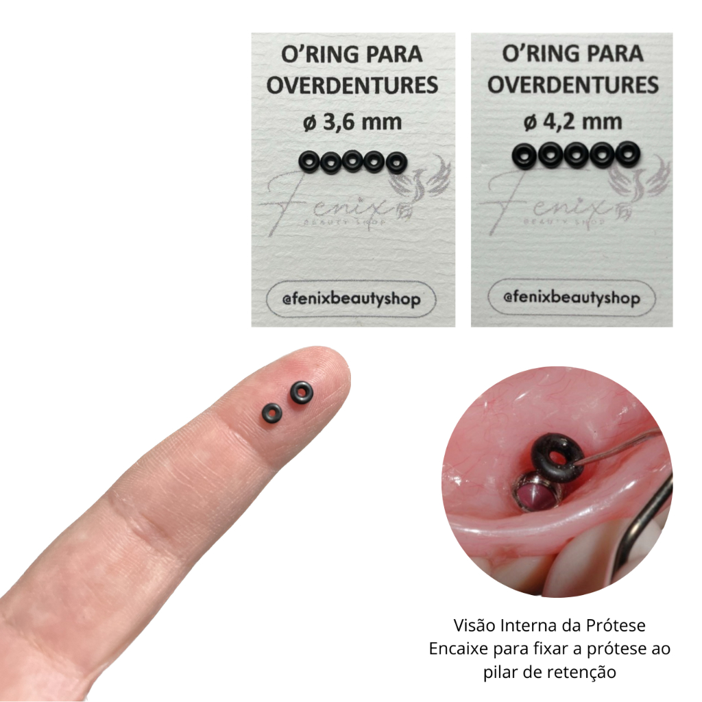 O-RING RETENÇÃO DO IMPLANTE ATTACHMENT BOLA MINI