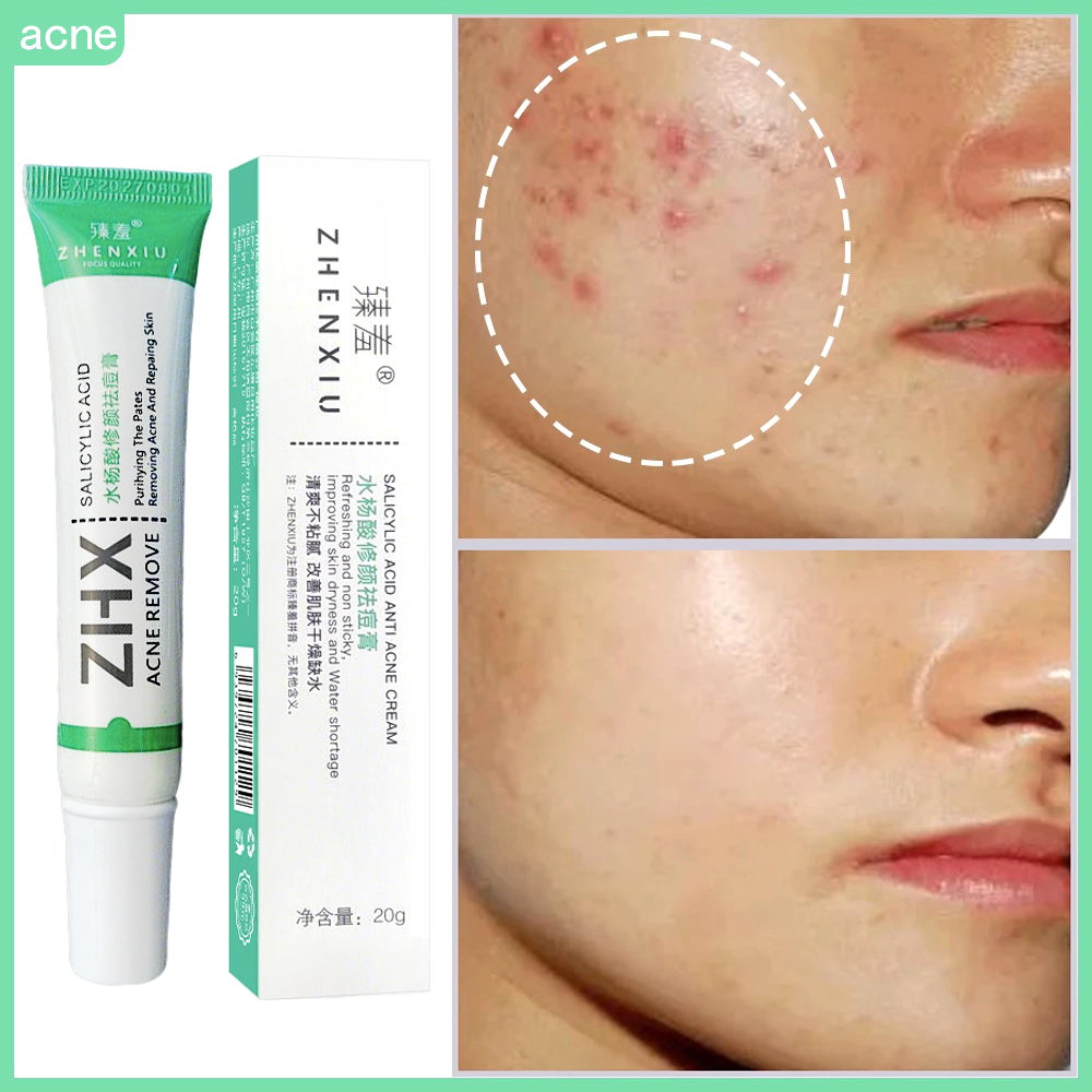 Ácido Salicílico Acne Creme Remover Cravo Contro