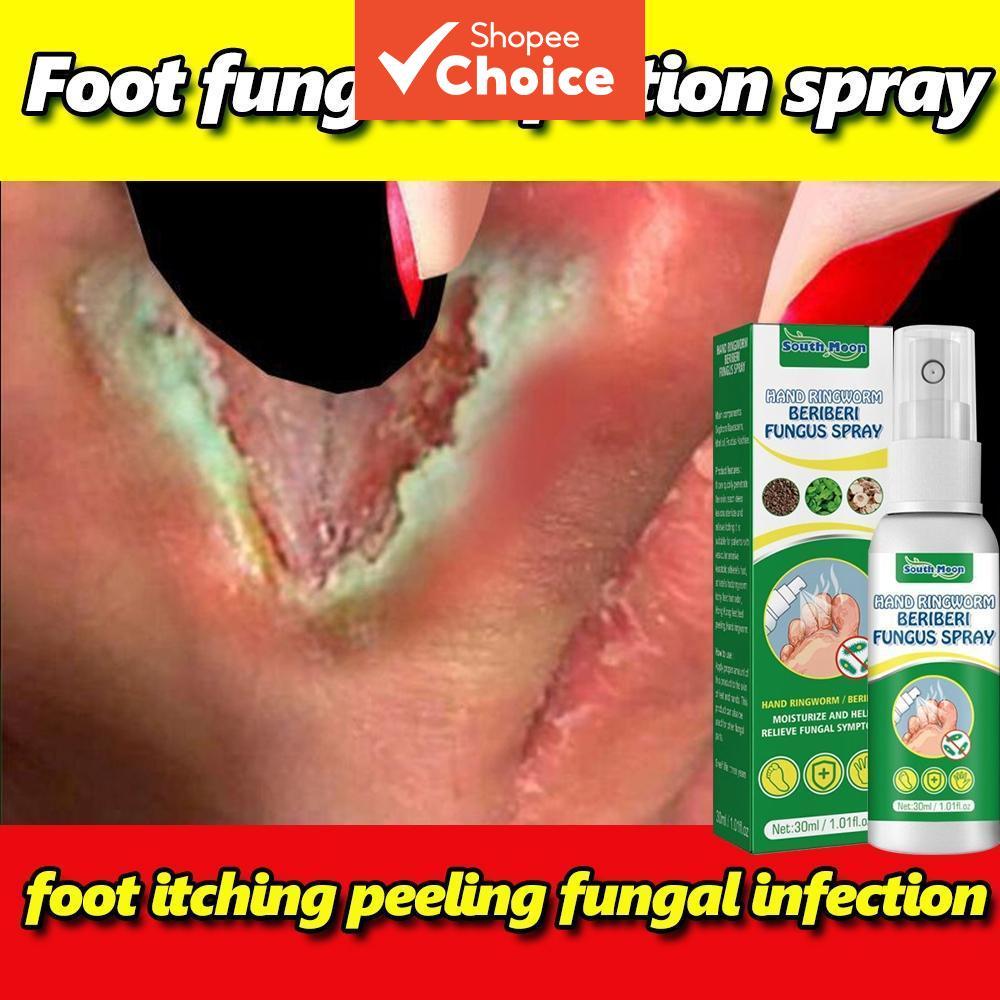 Tratamento eficaz para frieiras com nosso spray de