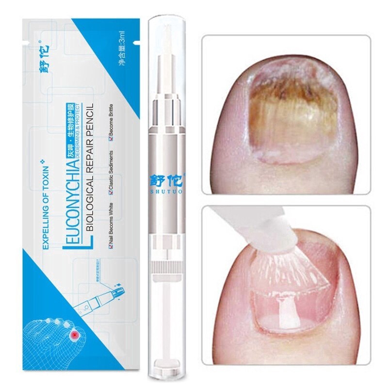 Prego Pen Onicomicose Paroníquia Infecção Herba