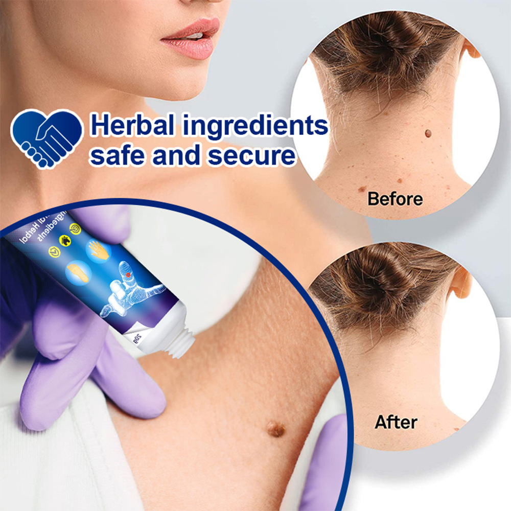 Creme Anti-Verrugas Para Sardas Suaviza Calos Hidr