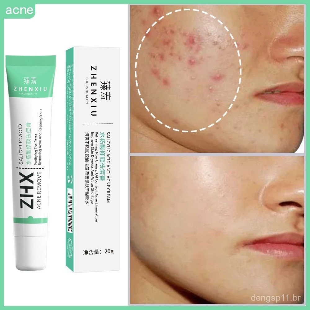 Creme Facial Anti-Acne com Ácido Salicílico para