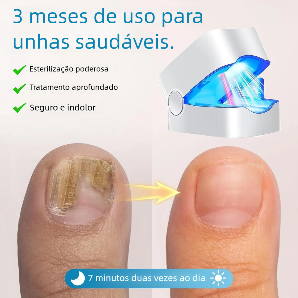 Tratamento de Onicomicose da Ponta do Dedo –